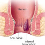 Internal-Hemorrhoid