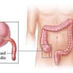 appendectomy-01