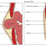 hernia