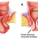 rectal-prolapse-SAMLL
