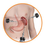 splenectomy-advantages