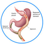Gastric-Bypass-512