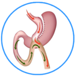 Mini-Gastric-Bypass-512